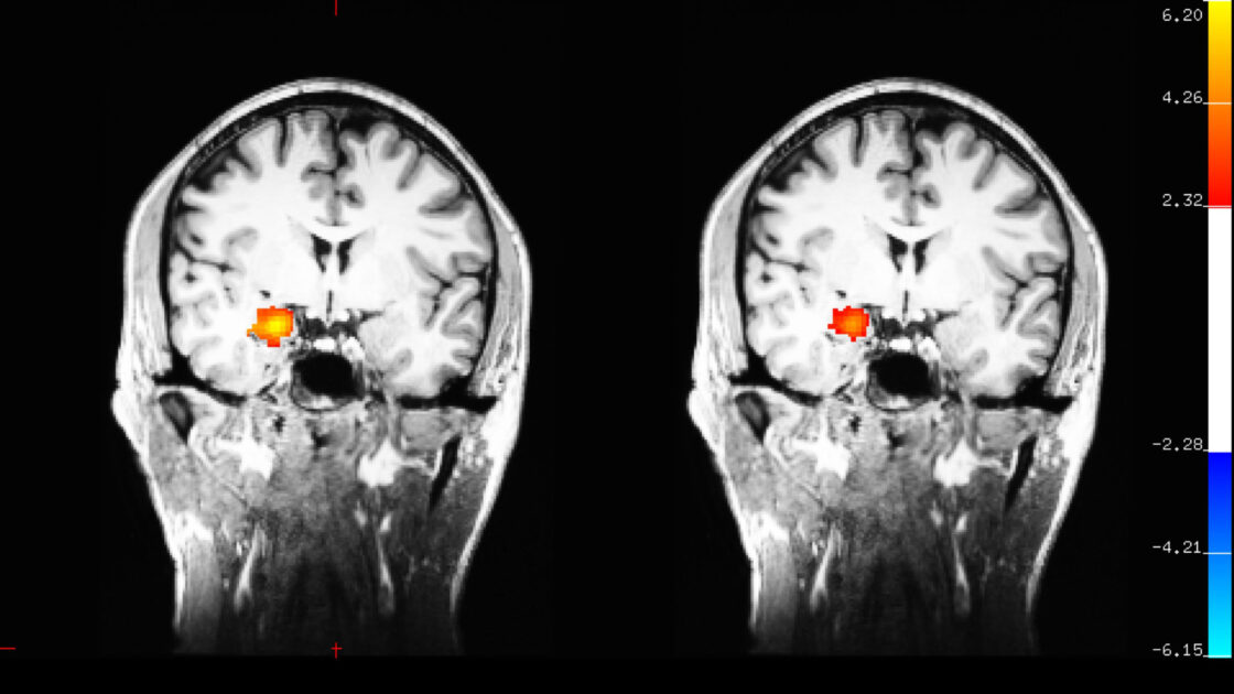 Impact of meditation on brain activity